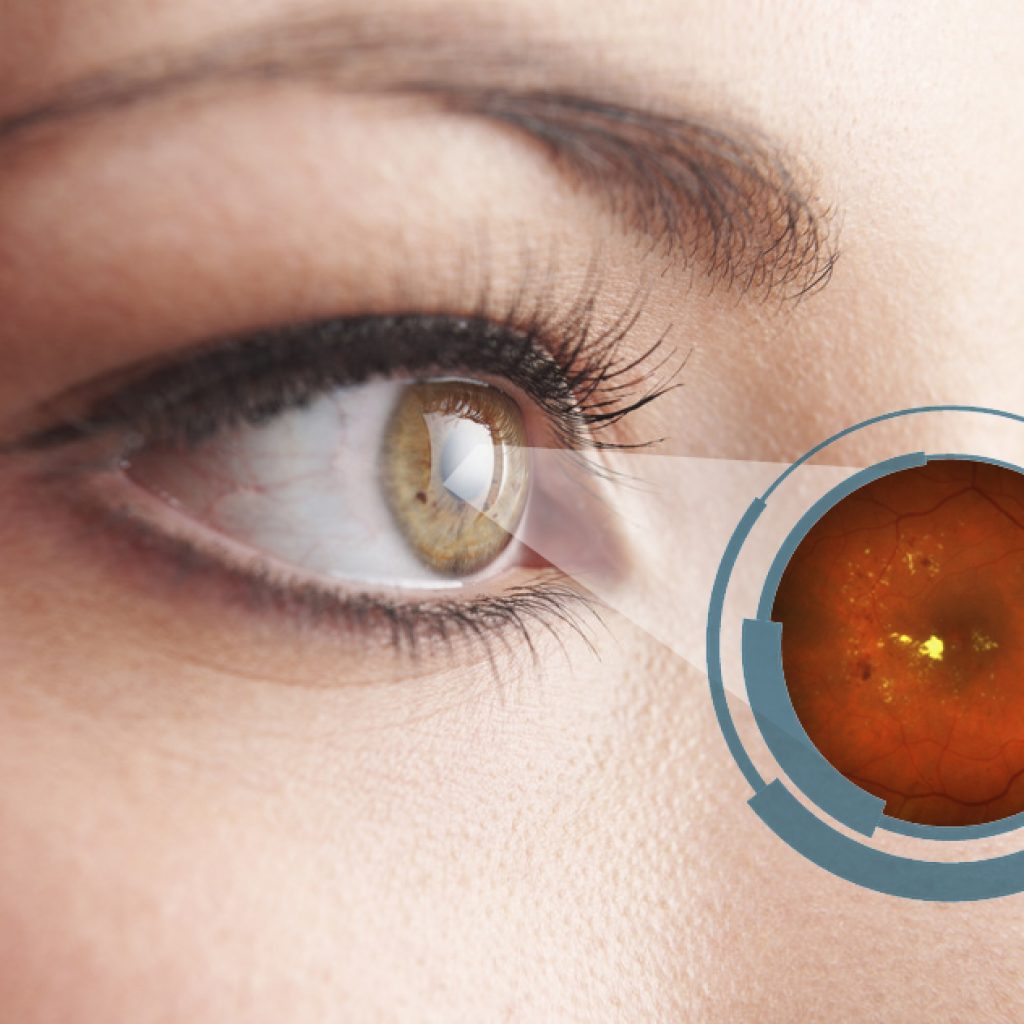 retinopatia