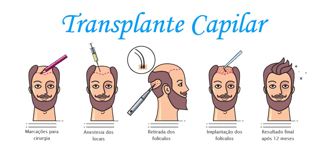 transplante capilar cirurgia
